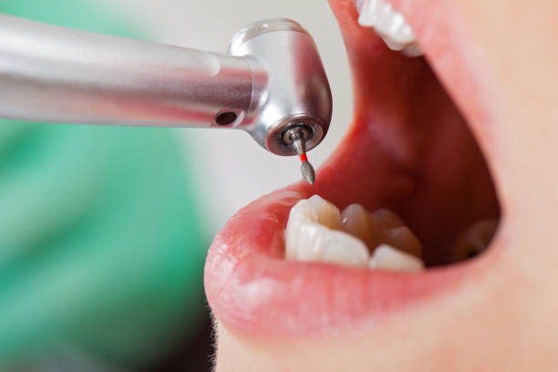 Best Emergency Tooth Extraction in Comanche, OK